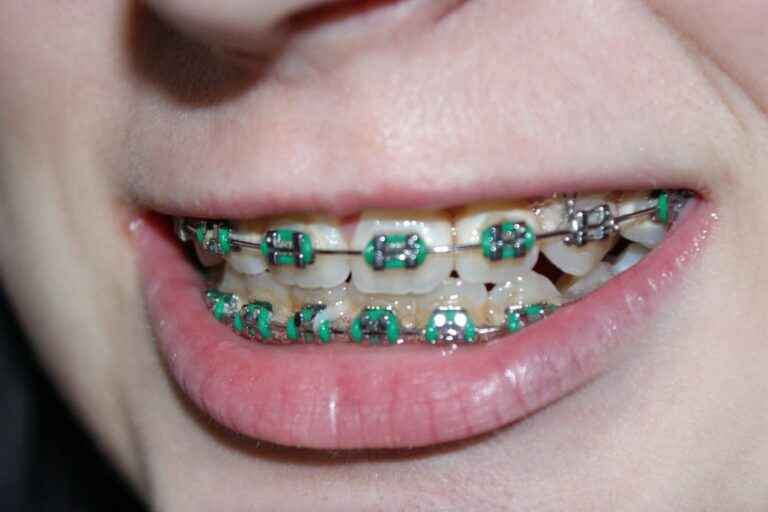 Traditional Braces (Full Treatment)