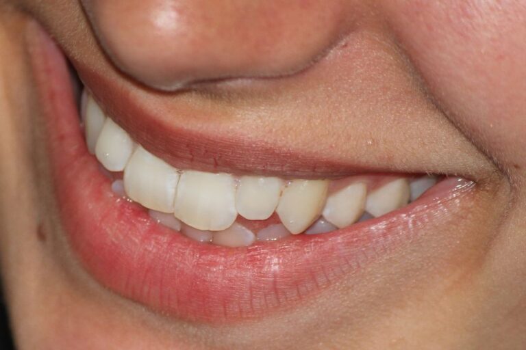 Cosmetic Bonding (per tooth)