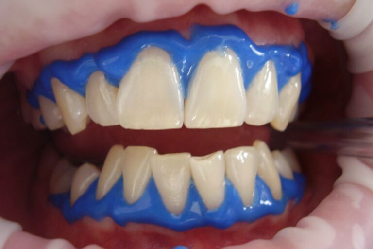 In-Office Teeth Whitening