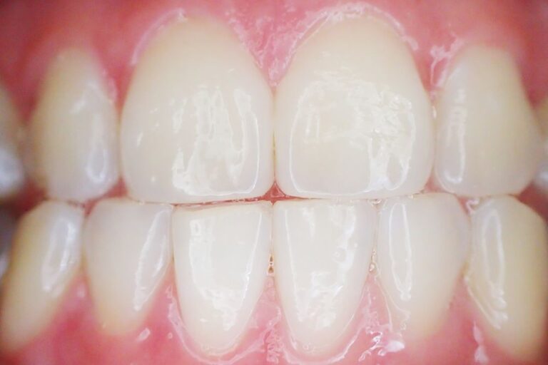 Porcelain Veneer (per tooth)