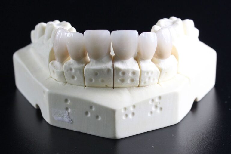 Single Tooth Implant (Post, Abutment & Crown)