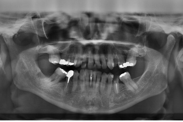 Wisdom Teeth Removal (All Four)